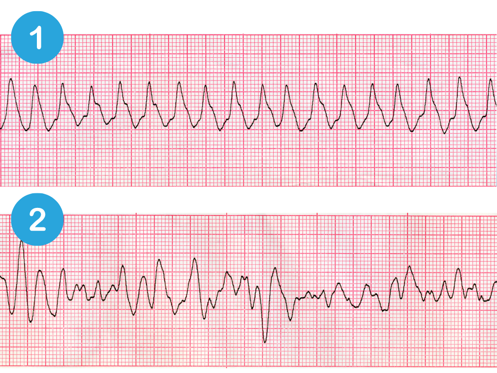 Common heart arrhythmia ECG rhythms
